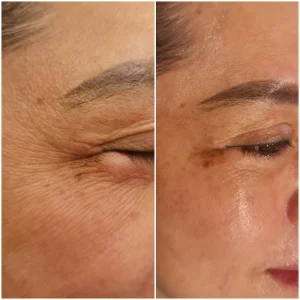 Alternative view of EYEVI EMS - Giải Pháp Toàn Diện Cho Đôi Mắt Trẻ Trung Không Tì Vết Siêu Hot 2025