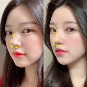 Alternative view of Nẹp Mũi Nhựa Nhiệt Dẻo - Giải Pháp Định Hình & Bảo Vệ Sống Mũi Hiệu Quả 2025