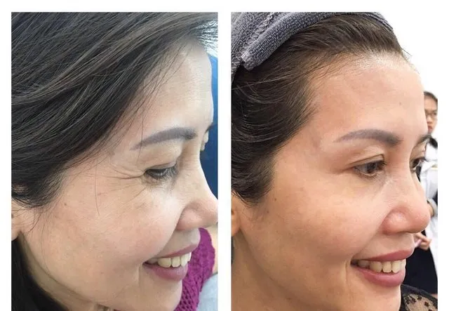 EYEVI EMS - Giải Pháp Toàn Diện Cho Đôi Mắt Trẻ Trung Không Tì Vết Siêu Hot 2025 - Ảnh 5