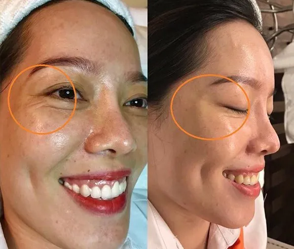 EYEVI EMS - Giải Pháp Toàn Diện Cho Đôi Mắt Trẻ Trung Không Tì Vết Siêu Hot 2025 - Ảnh 6